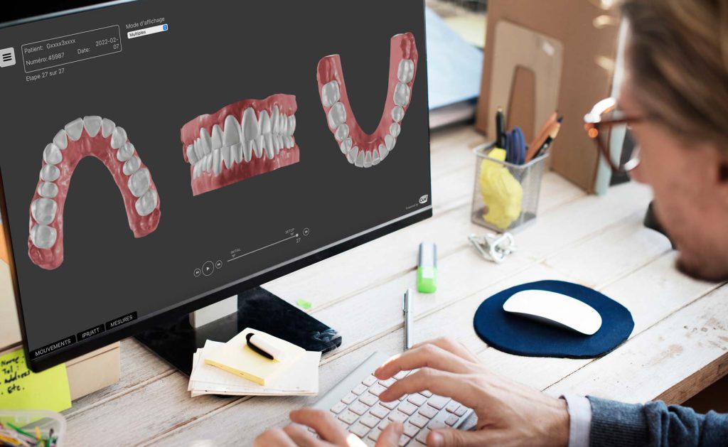 Cutting-edge 3D CAD software to design clear aligners