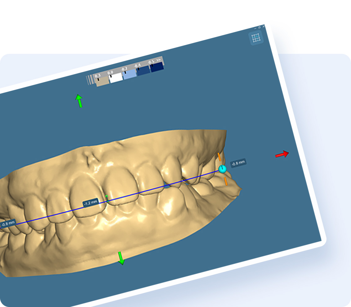 Occlusal Adjustment